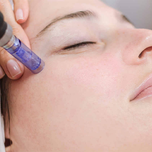 Microneedling au Centre LASER Saint-Rémy